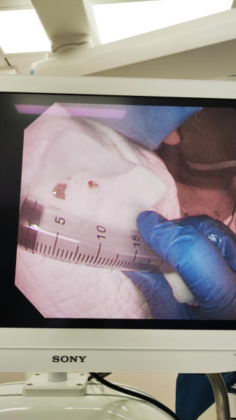 支气管镜有哪些牌子有“镜”无险———支气管镜下气道异物取出术_https://www.jmylbn.com_新闻资讯_第2张