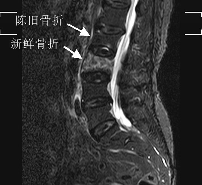 腰背突然疼痛,居然被诊断为骨折?293 腰背突然疼痛,居然被诊断为骨折?293