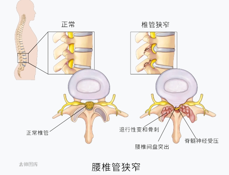 椎管狭窄