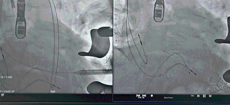经导管主动脉瓣置换术（TAVR）