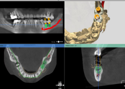 2-数字化种植牙,启航种牙新时代!194 2-数字化种植牙,启航种牙新时代!194