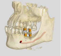 2-数字化种植牙,启航种牙新时代!192 2-数字化种植牙,启航种牙新时代!192
