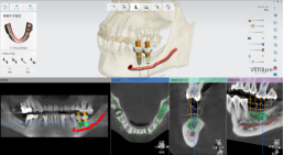 2-数字化种植牙,启航种牙新时代!193 2-数字化种植牙,启航种牙新时代!193