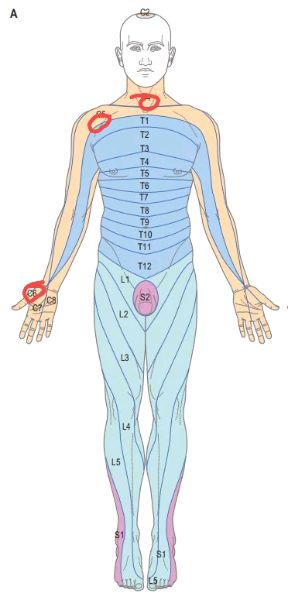 患者问题颈椎正面示意图。