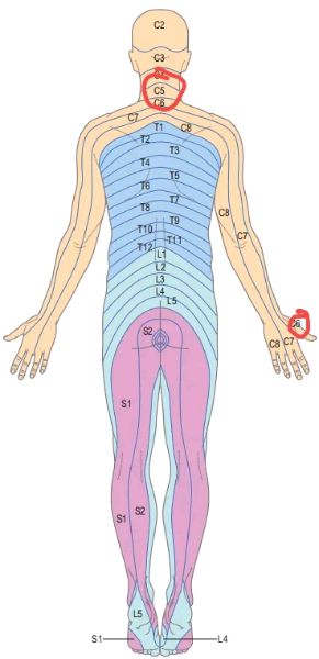 患者问题颈椎背面示意图。